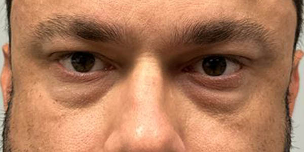 _0012_PT 101 before lower bleph and facial fat grafting front.JPG