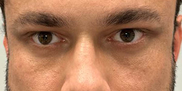 _0013_PT 101 after lower bleph and facial fat grafting front.JPG