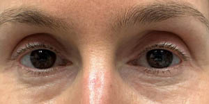 0013_PT14-Front-After-Lower-Bleph-W-fat-grafting.jpg