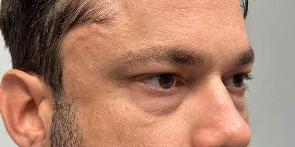 _0014_PT 101 before lower bleph and facial fat grafting side.JPG