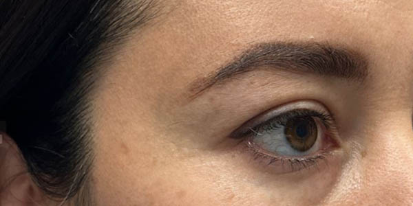 1_0000_patient 101 before upper bleph with subbrow filler.JPG