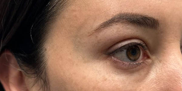 1_0001_patient 101 after upper bleph with subbrow filler.JPG