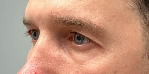 1_0004_PT 50– before upper bleph with direct brow lift and subbrow filler (side).jpg