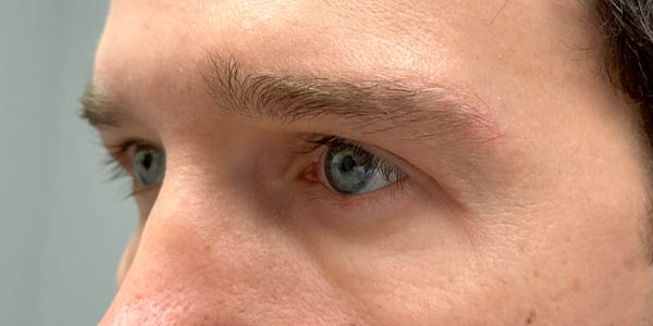 1_0005_PT 50– after upper bleph with direct brow lift and subbrow filler(side).jpg