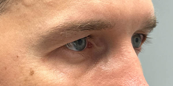 1_0006_PT 50– before upper bleph with direct brow lift (side2).jpg