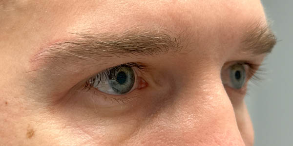 1_0007_PT 50– after upper bleph with direct brow lift and subbrow filler(side2).jpg