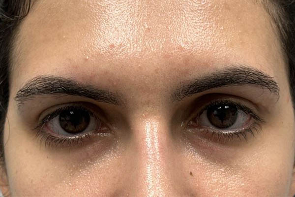 _0000_patient 7 before subbrow filler.JPG