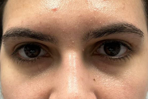 _0001_patient 7 after subbrow filler.JPG