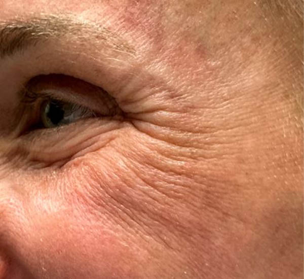 _0002_patient 101 before lower bleph with co2, facial fat grafting and pre surgical hyaluronidase side smiling.JPG