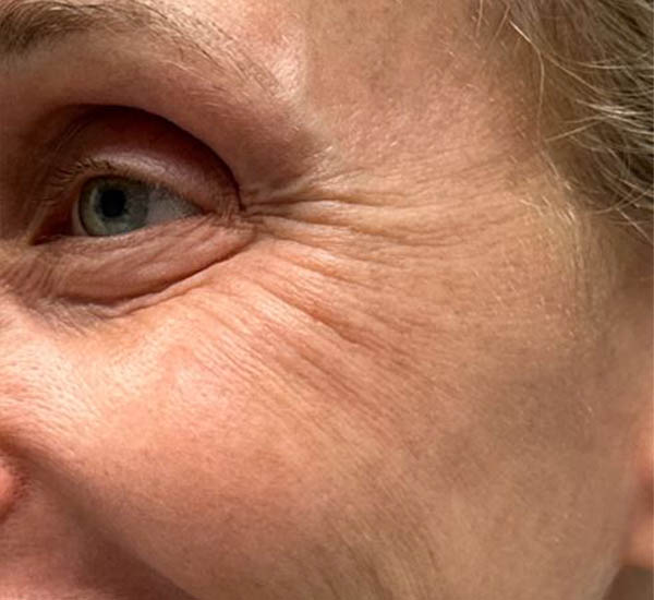 _0003_patient 101 after lower bleph with co2, facial fat grafting and pre surgical hyaluronidase side smiling.JPG