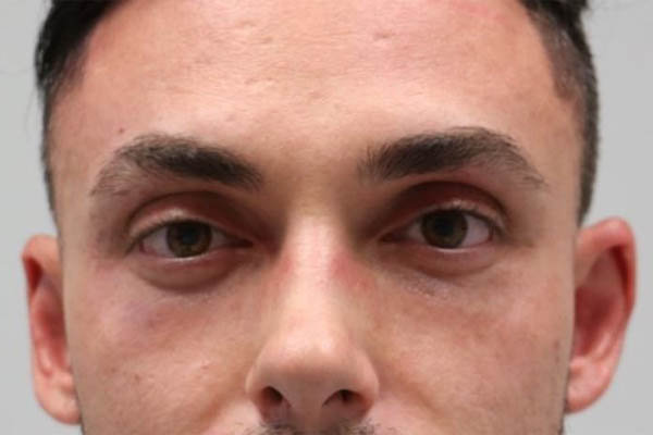_0004_patient 9 before subbrow filler.JPG