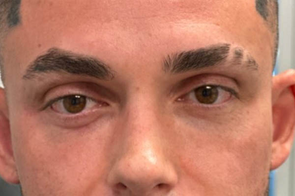 _0005_patient 9 after subbrow filler.JPG