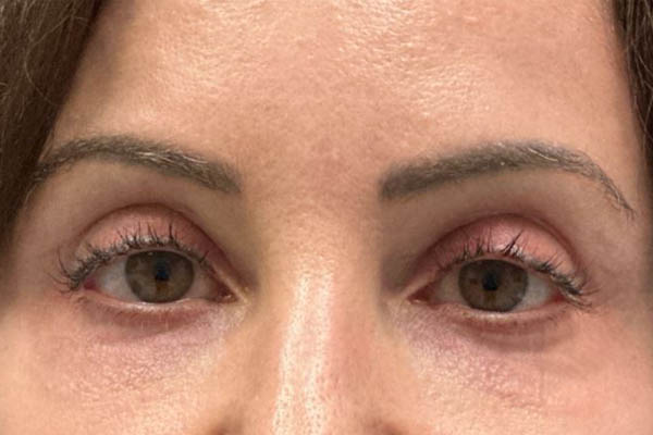 _0006_patient 10 before subbrow filler.JPG