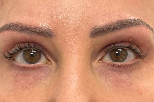 _0007_patient 10 after subbrow filler.JPG