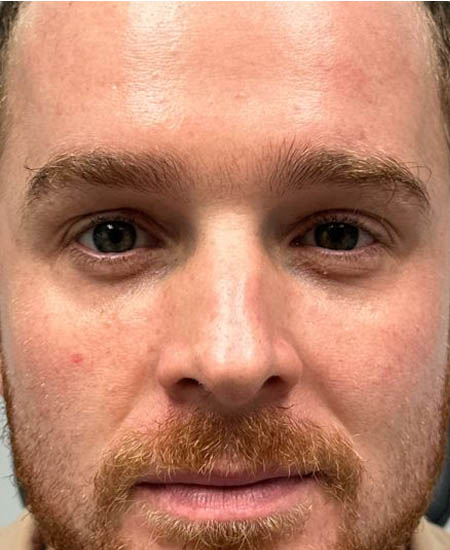 1_0000_patient 10 before dissolving under eye filler.JPG