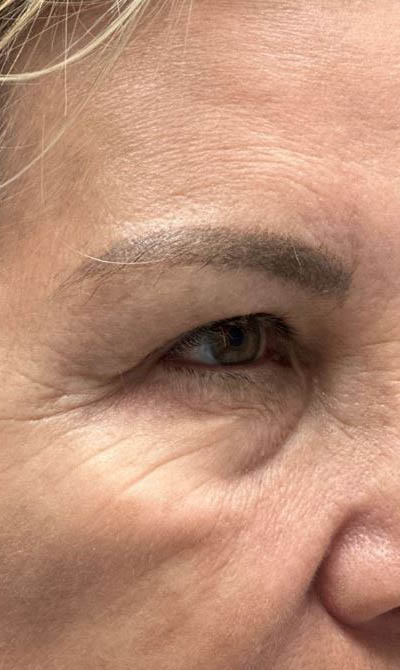 1_0000_patient 103 before upper bleph.JPG
