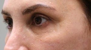 1_0000_patient 11 before dissolving under eye filler.JPG