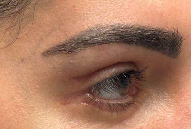 1_0000_patient 5 scar revision– before 1 5FU injection– right side.JPG