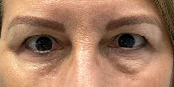 1_0000_patient 8 before quad bleph with facial fat grafting.JPG copy