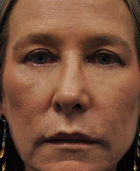 1_0000_patient 9 after CO2 laser.JPG