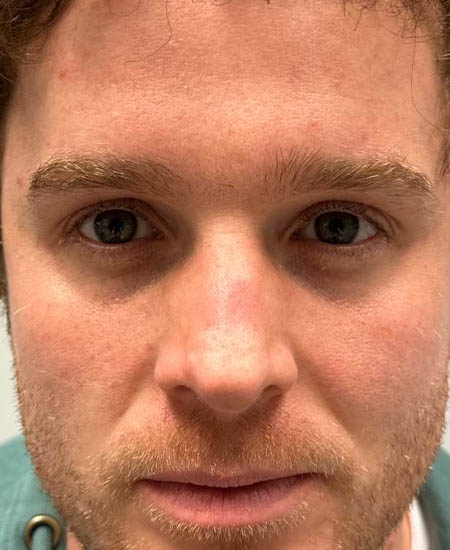 1_0001_patient 10 after dissolving under eye filler.JPG