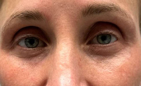 1_0001_patient 101 after lower bleph with co2, facial fat grafting and pre surgical hyaluronidase front.JPG