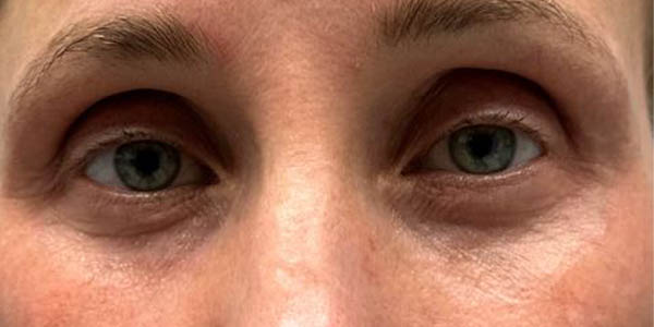 1_0001_patient 101 after lower bleph with co2, facial fat grafting and pre surgical hyaluronidase front.JPG