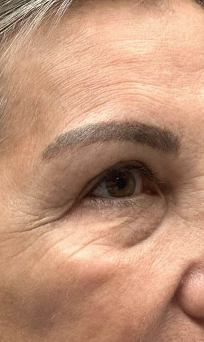 1_0001_patient 103 after upper bleph.JPG