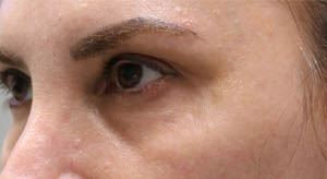 1_0001_patient 11 after dissolving under eye filler.JPG
