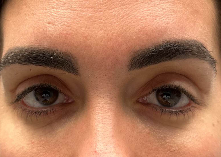 1_0001_patient 5 scar revision– after 1 5FU injection– front.JPG