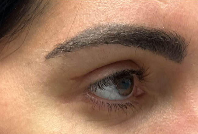 1_0001_patient 5 scar revision– after 1 5FU injection– right side.JPG