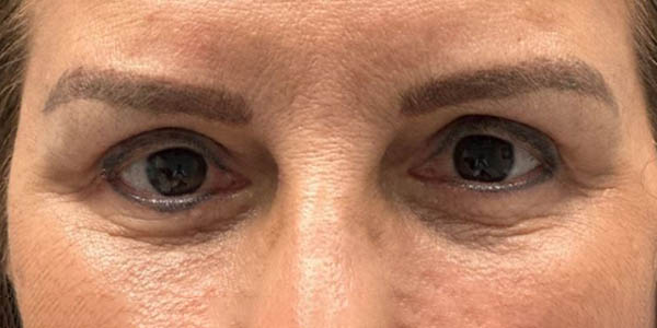 1_0001_patient 8 after quad bleph with facial fat grafting.JPG copy