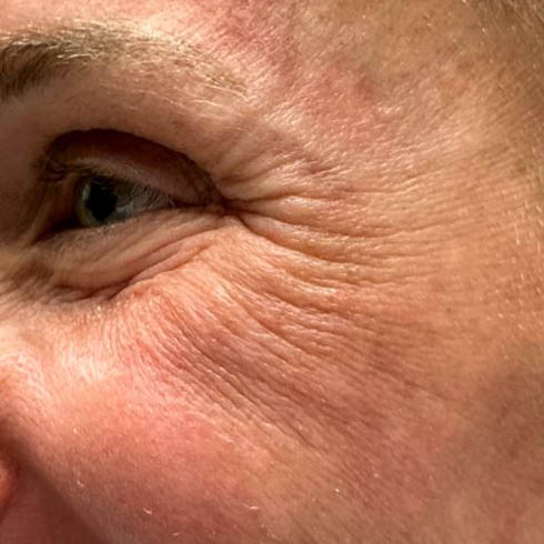 1_0002_patient 101 before lower bleph with co2, facial fat grafting and pre surgical hyaluronidase side smiling.JPG