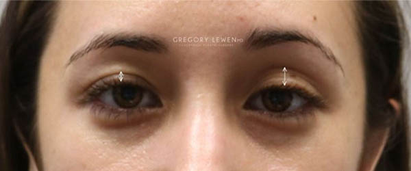 1_0002_patient 11 before subbrow filler.JPG