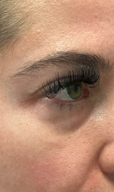 1_0002_patient 55 before lower bleph with facial fat grafting.JPG