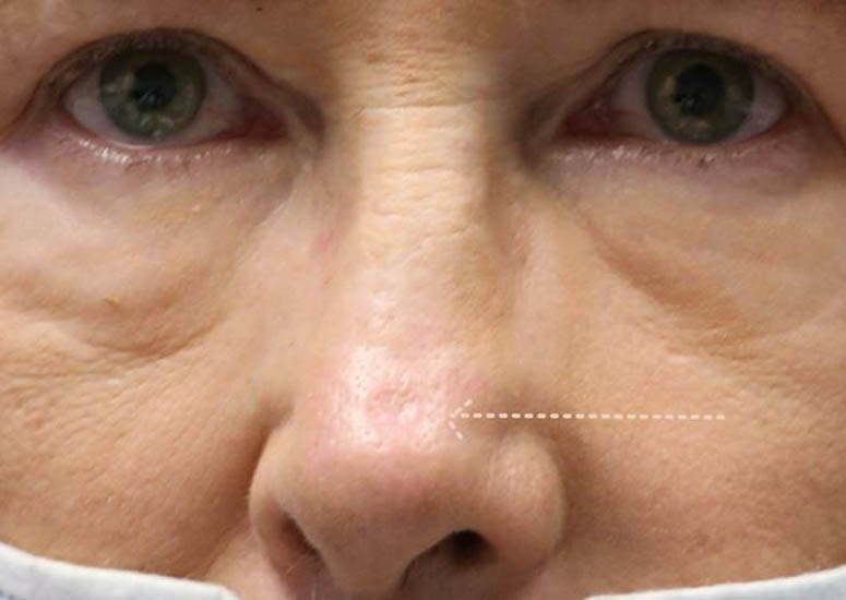 1_0002_patient 6 scar revision– before 1 morpheus session.JPG