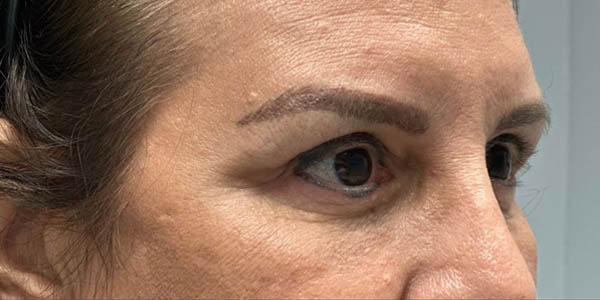 1_0002_patient 8 after quad bleph with facial fat grafting–side.JPG