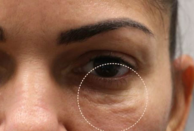 1_0002_patient 8 scar revision– before 1 morpheus session.JPG