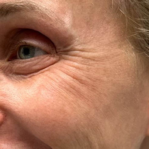 1_0003_patient 101 after lower bleph with co2, facial fat grafting and pre surgical hyaluronidase side smiling.JPG