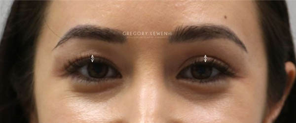1_0003_patient 11 after subbrow filler.JPG