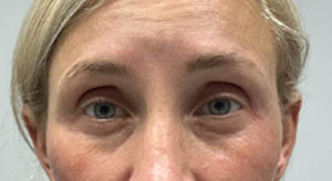 1_0003_patient 12 after dissolving under eye filler.JPG