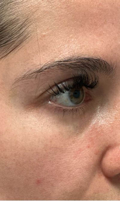 1_0003_patient 55 after lower bleph with facial fat grafting.JPG