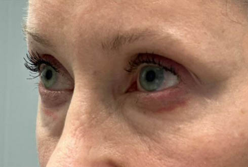 1_0003_patient 6 before lower bleph with facial fat grafting and CO2r–side.JPG