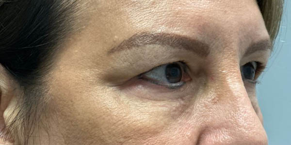 1_0003_patient 8 before quad bleph with facial fat grafting–side.JPG
