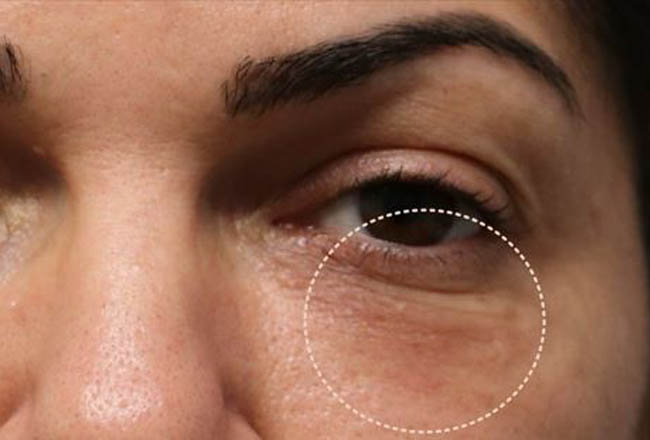 1_0003_patient 8 scar revision– after 1 morpheus session.JPG