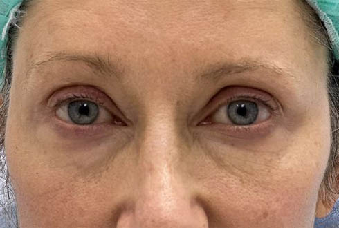 1_0004_patient 6 before lower bleph with facial fat grafting and CO2.JPG