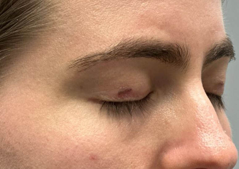 1_0004_patient 9 before CO2 for eyelid scars–side.JPG
