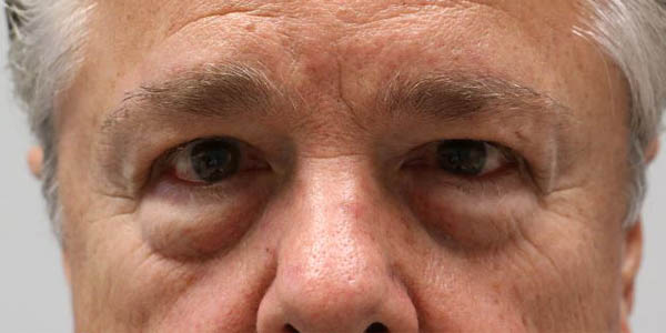 1_0004_patient 9 before quad bleph with facial fat grafting.JPG