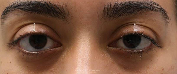 1_0005_patient 12 after subbrow filler.JPG