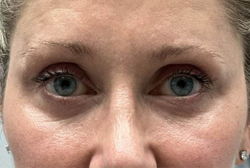 1_0005_patient 6after lower bleph with facial fat grafting and CO2.JPG